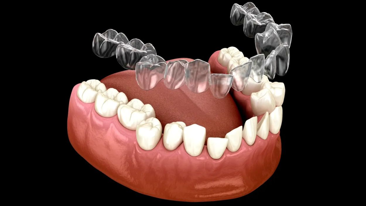clear aligners