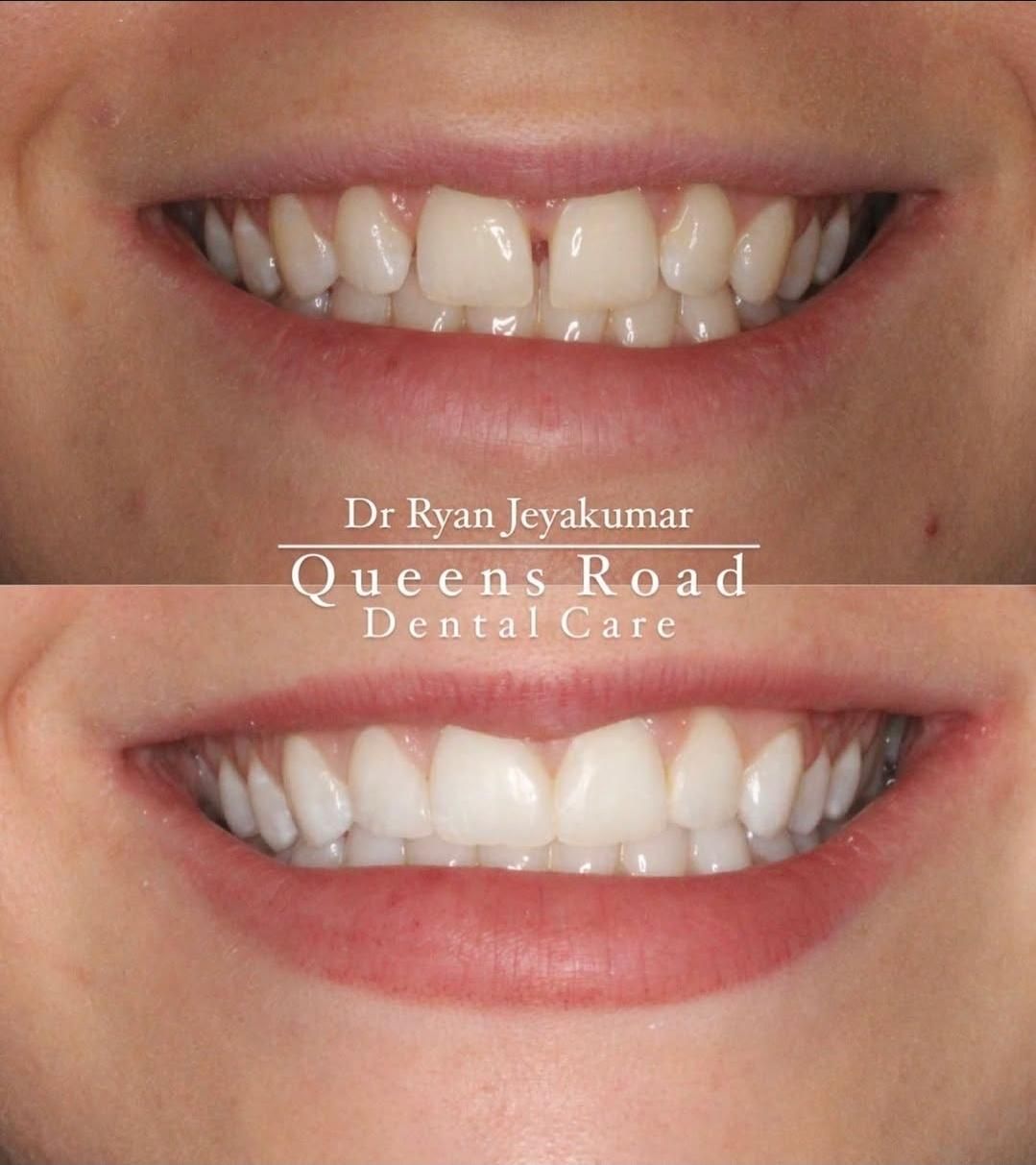 Composite bonding at Queens