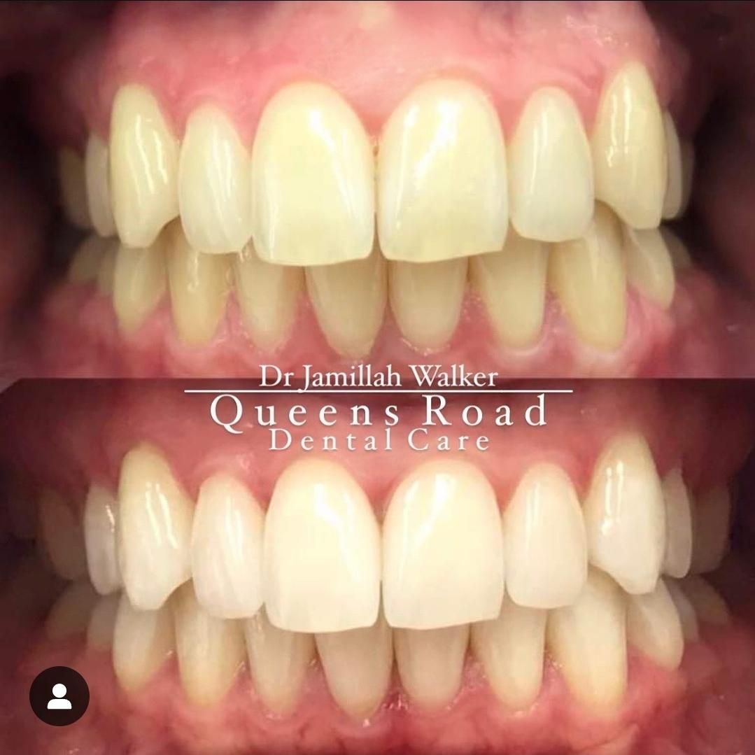 Whitening at Queens