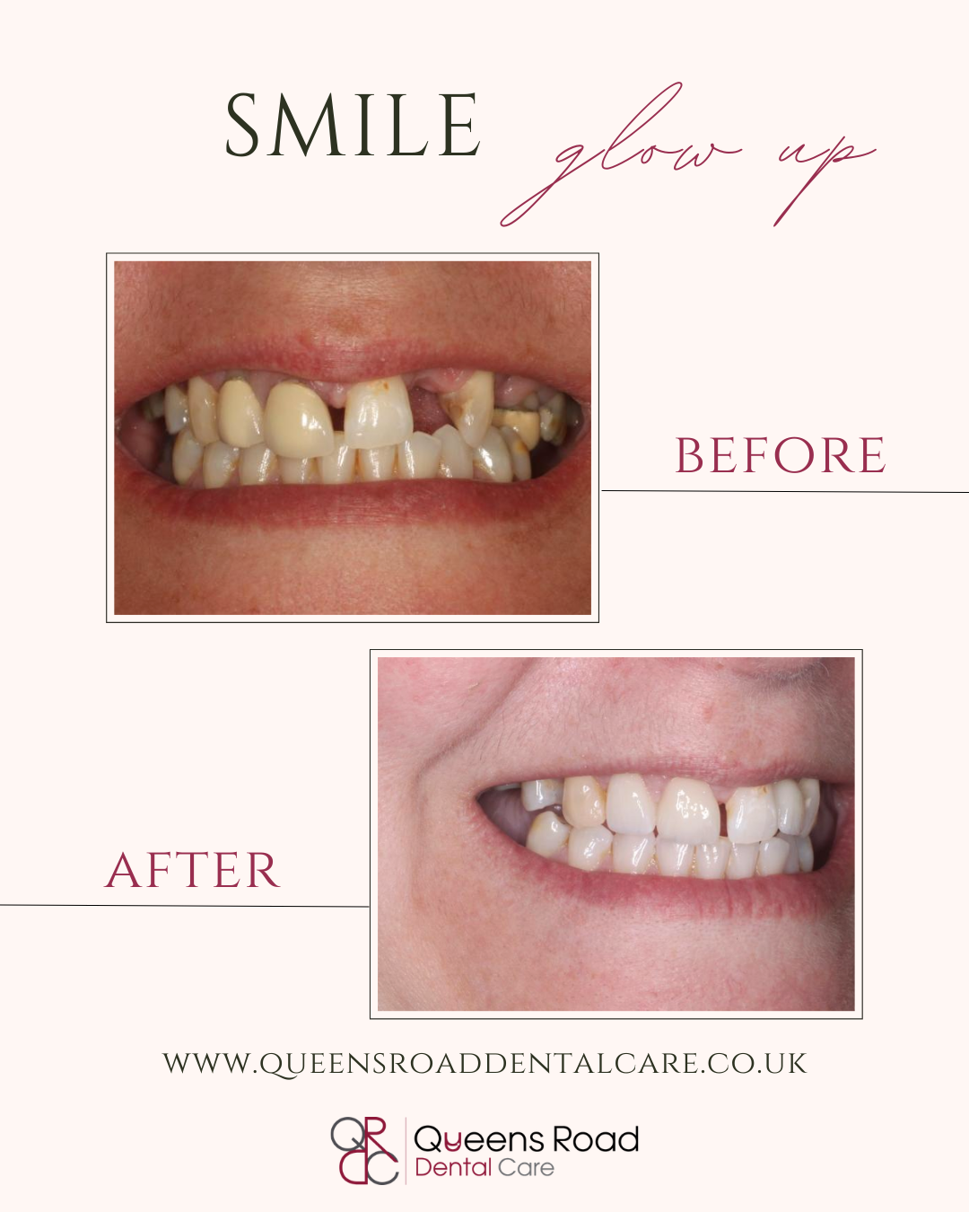 Implants at Queens Dental