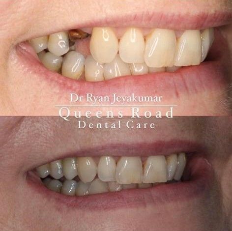 Implants at Queens Dental
