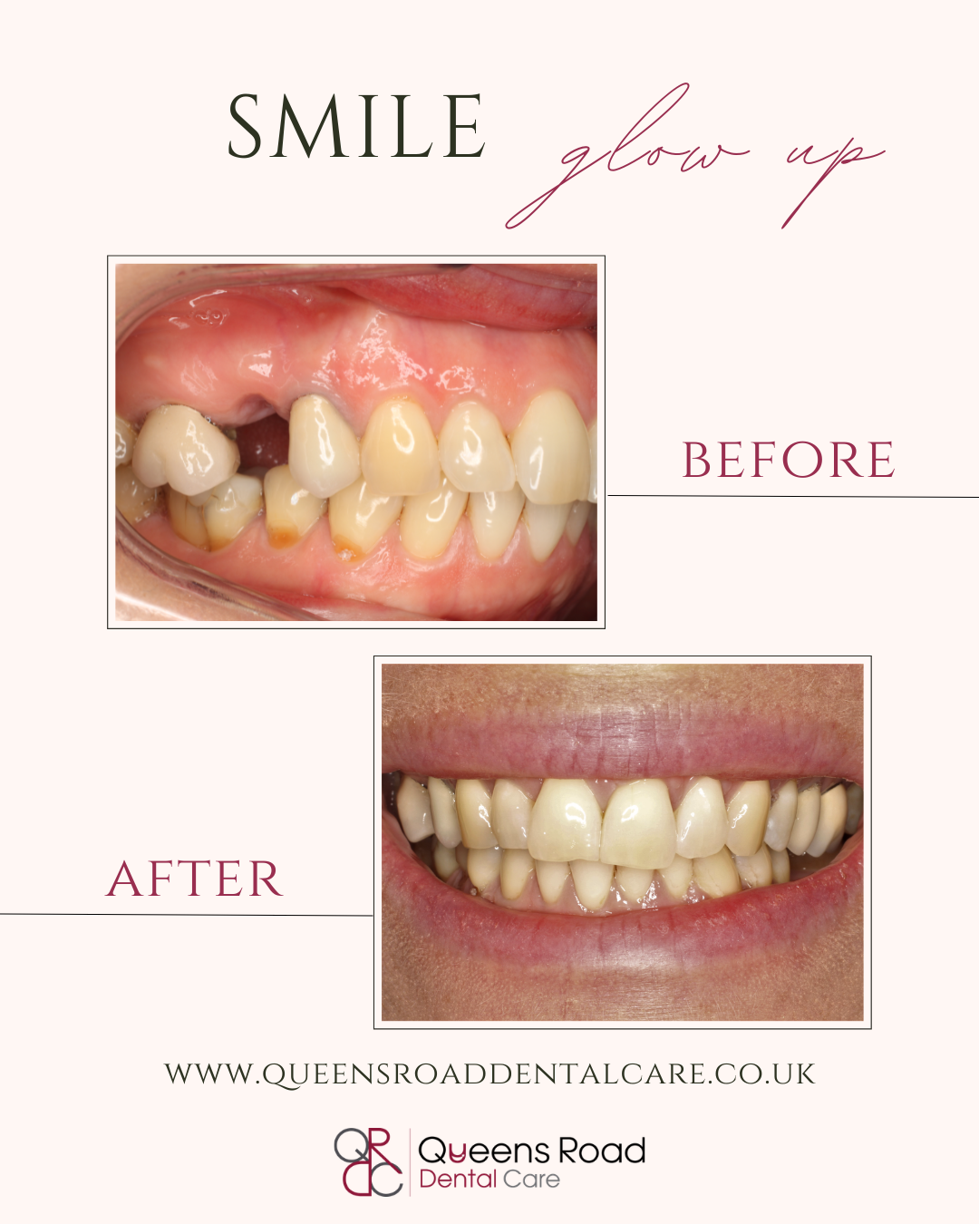 Queens Implant treatment at Queens Road Dental Care