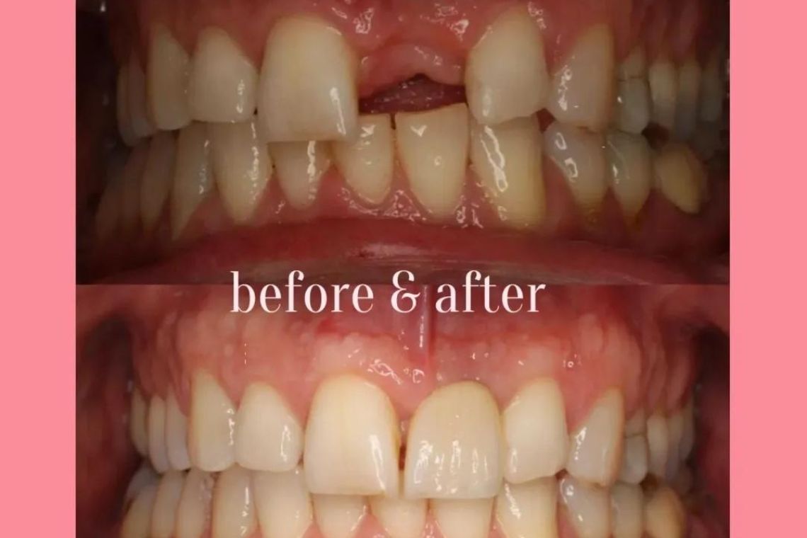 Implants at Queens Dental