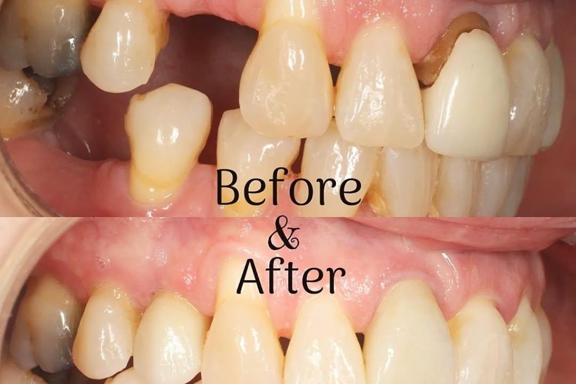 Implants at Queens Dental